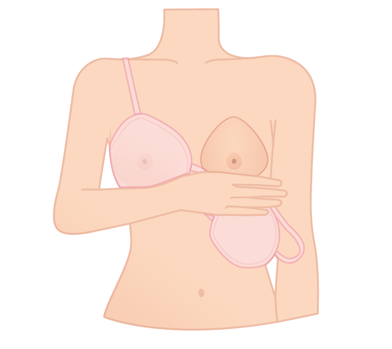 prothèse mammaire externe silicone Prothèse mammaire externe MEAVANTI